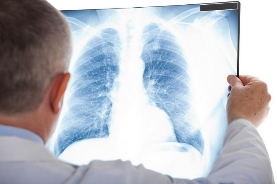 FOT. Fotolia; zdjęcie ilustracyjne Polscy pneumonolodzy wreszcie z nową opcją terapeutyczną w leczeniu POChP