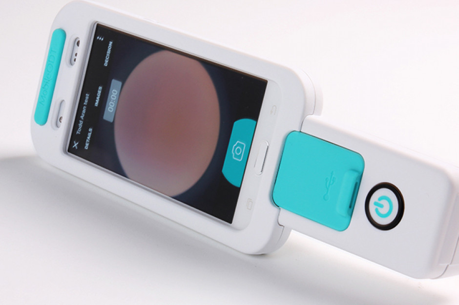 System EVA to m.in. cyfrowe urządzenie optyczne oparte na dedykowanym smartfonie; FOT. www.aran-rd.com Eksperci: system wykorzystujący sztuczną inteligencję wspiera diagnostykę raka szyjki macicy