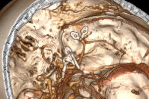 Wrocław: neurochirurdzy uratowali pacjentkę z pięcioma tętniakami