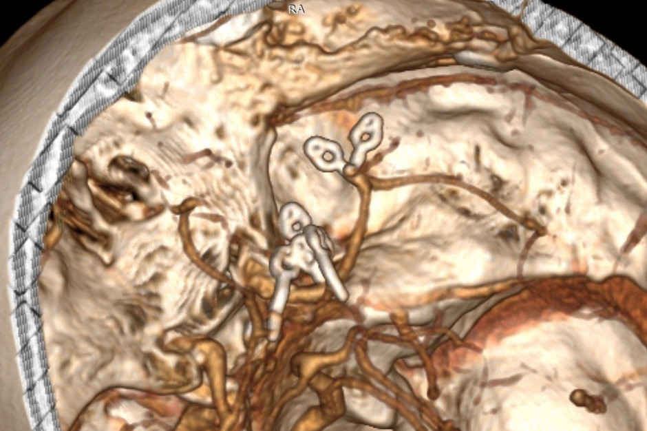 Tętniaki; FOT. Szpital im. Marciniaka we Wrocławiu Wrocław: neurochirurdzy uratowali pacjentkę z pięcioma tętniakami