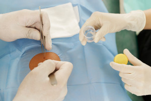 Prosta biopsja skóry pokazuje stan pacjentów z COVID-19