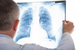 Rak płuc największym wyzwaniem dla onkologii. ABM przypomina o niepokojących statystykach