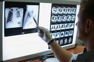 Rak płuca w Polsce: jak oceniają nas w Europie? "W tym roku ścieżka pacjenta"