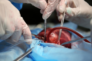 Prof. Kuśmierczyk: sztuczne komory serca coraz częściej wszczepia się docelowo, a nie w oczekiwaniu na przeszczep