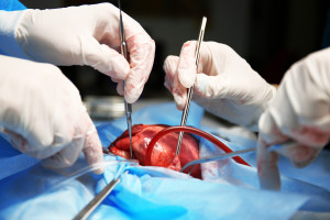 Kardiochirurdzy z WUM wszczepili sztuczną komorę serca nowej generacji