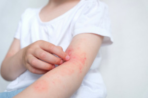 Atopowe zapalenie skóry. Niedługo rusza wyczekiwana refundacja terapii dla dzieci i młodzieży