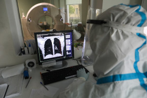 Badanie RTG może wykryć długi COVID w płucach. Naukowcy opracowali nowy model