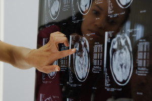 Alzheimer wykryty na długo przed objawami? Naukowcy wskazali, jak rozpoznać chorobę