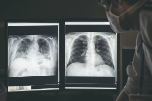 Wyniki badania leku wskazują, że redukuje ryzyko nawrotu raka płuca aż o 80 proc.