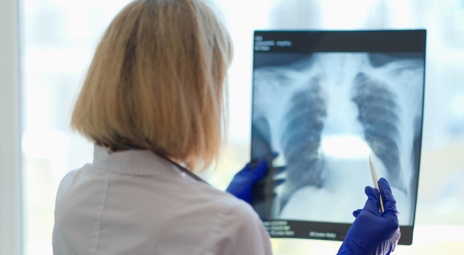 Nowe metody leczenia raka płuca: rosną szanse medycyny w walce z tym nowotworem