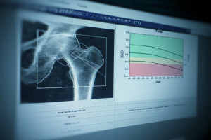 Choroby kości: naukowcy z GUMed z wynalazkiem chronionym patentem