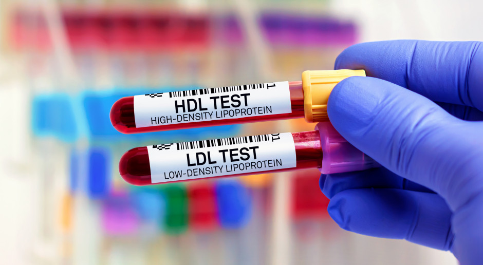 Hipercholesterolemia, to czynnik ryzyka zawału serca, na który mamy wpływ. Fot. AdobeStock Wysoki cholesterol zwiększa ryzko zawału serca i udaru. Tylko co piąty Polak zna swój lipidogram