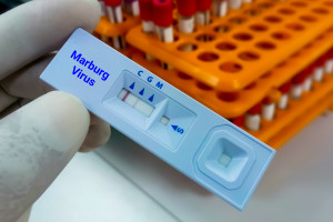Ekspert o ryzyku rozprzestrzenienia się wirusa Marburg. "Nie mamy leku ani szczepionki"