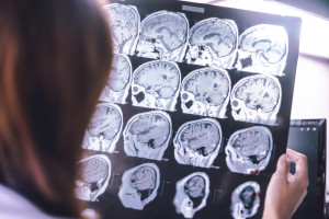 Naukowcy szukają chętnych do badań nad diagnozowaniem choroby Alzheimera