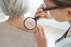 Los cánceres de piel son cada vez más comunes.  Experto en prevención, síntomas y tratamiento