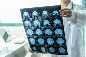 Neurolodzy: aby lepiej leczyć choroby mózgu, konieczne są inwestycje w neurologię