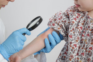 Cztery najczęstsze choroby alergiczne u dzieci mogą mieć wspólną przyczynę