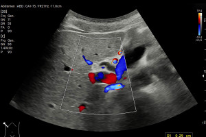 It devastates the liver at a lightning speed. The first symptoms are harmless.