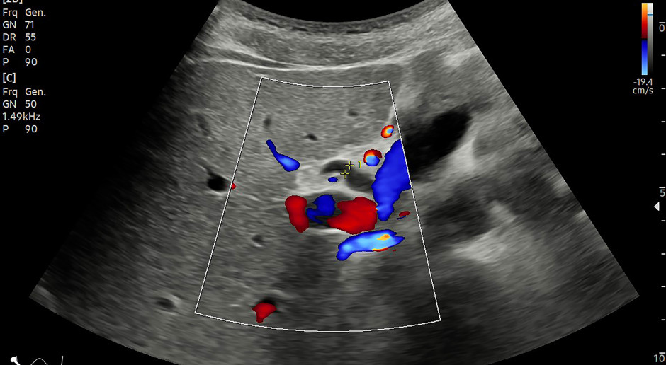 W piorunującym tempie dewastuje wątrobę. Pierwsze objawy są niewinne