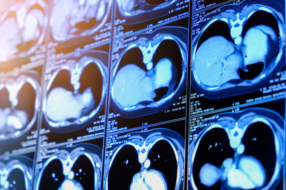 Nowa broń przeciw alkoholowej chorobie wątroby. Rewolucyjne odkrycie naukowców