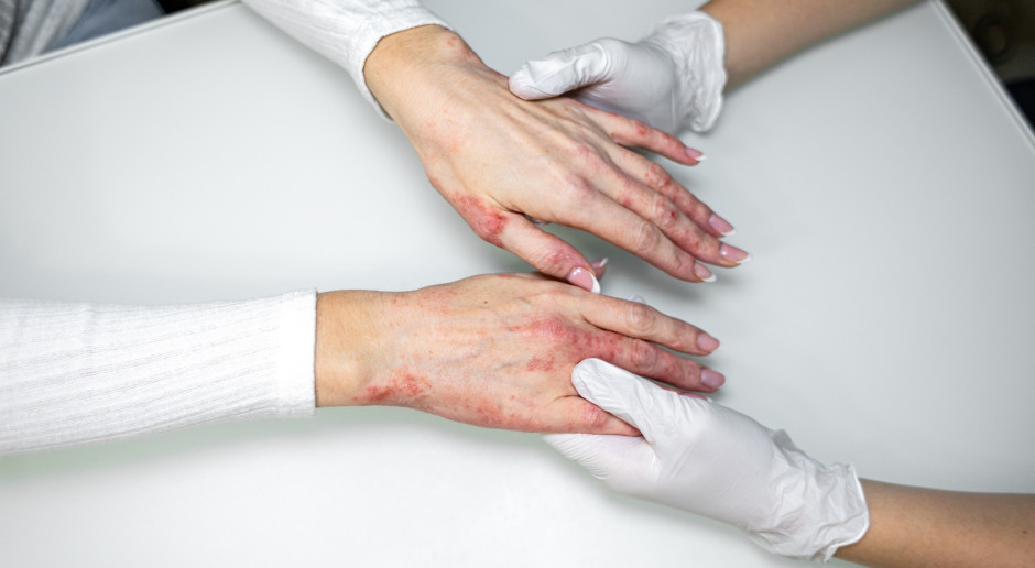 Kończą się umowy. Pilotaż dla pacjentów z deformującą chorobą genetyczną wydłużony