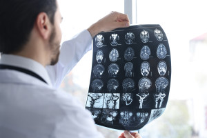 Stwardnienie rozsiane a borelioza. Czy można je pomylić?