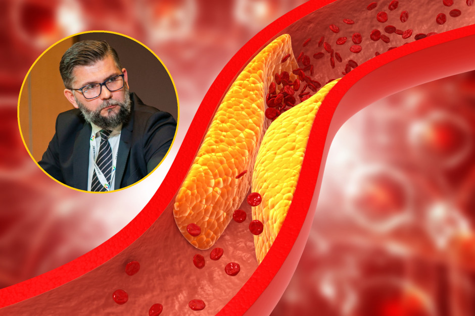 26 milionów Polaków zagrożonych. Są nowe wytyczne Polskiego Towarzystwa Lipidologicznego