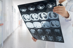 5 lat wystarczyło, by całkowicie cofnąć marskość wątroby. Jedna zmiana