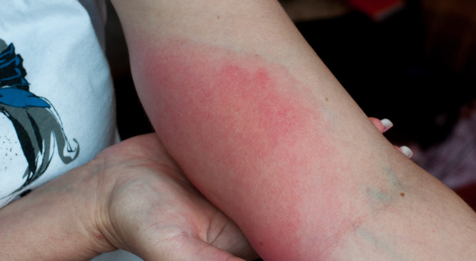 Coraz więcej zakażonych. To już nie jest problem sezonowy