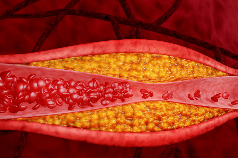 Gorsza niż "zły" cholesterol. Zawał i udar w pakiecie, dobre wyniki mogą uśpić czujność