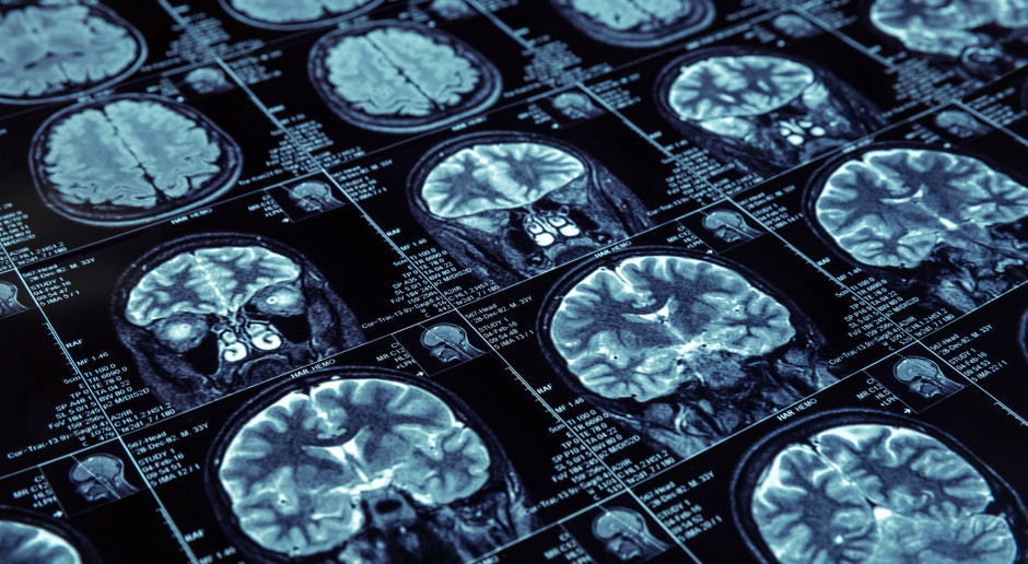Choroby prionowe a Alzheimer i Parkinson: to łączy źle zwinięte białka