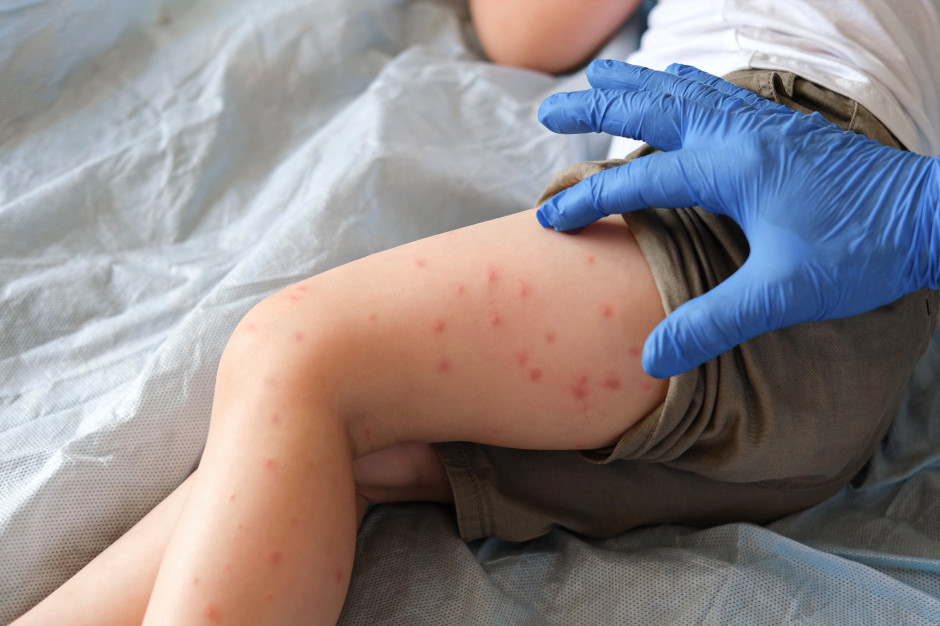 180 tys. chorych, 986 dzieci zmarło. Szaleje epidemia odry w Bangladeszu