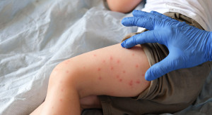 180 tys. chorych, 986 dzieci zmarło. Szaleje epidemia odry w Bangladeszu
